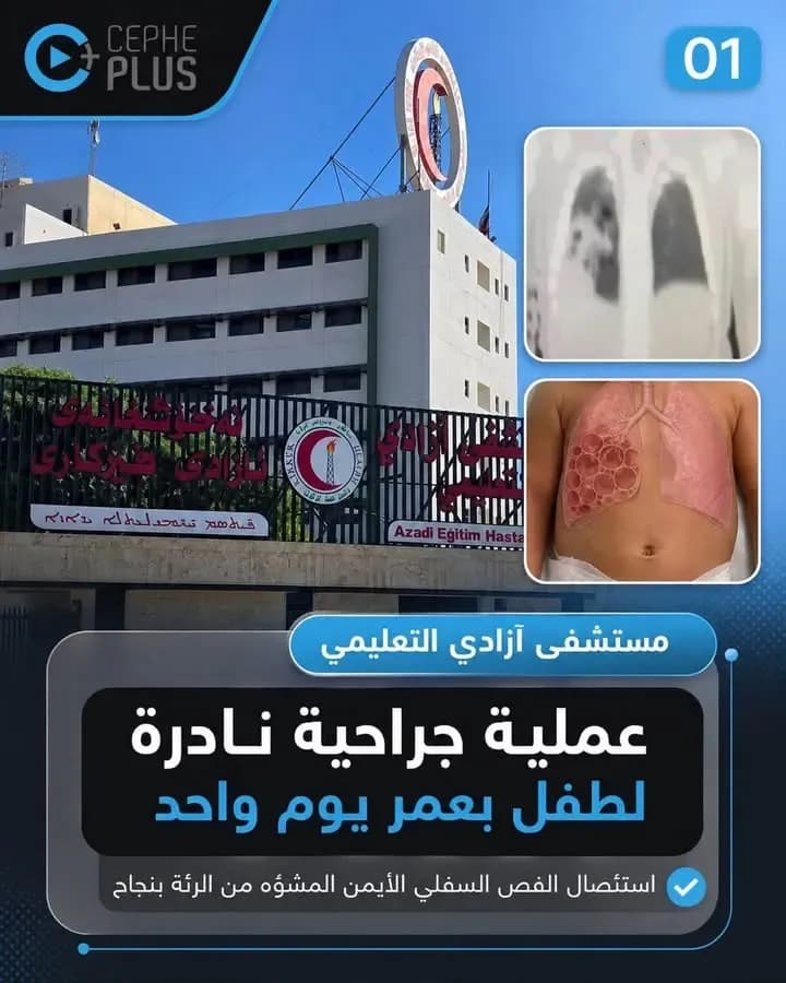 مستشفى آزادي التعليمي يعلن نجاح فريق طبي متخصص في إجراء عملية جراحية…